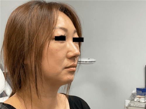 Agnes RF Facelift case photographs