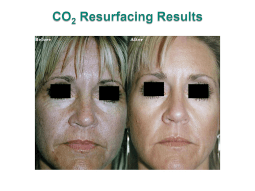 CO₂ Laser Resurface case photographs