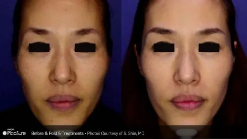 PicoSure Laser before and after photograph 1