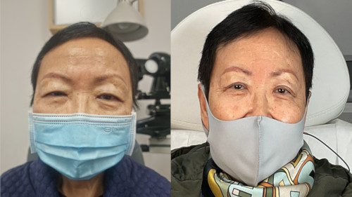 Upper Eyelift before and after photograph 1